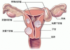 女性体内潜伏的威胁——子宫肌瘤