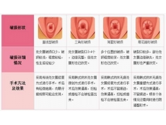 Venus私密整形—处女膜重塑技术