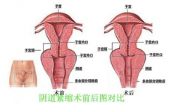 阴道紧缩术让您更加“幸福”