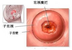 得了宫颈糜烂的症状有哪些表现?