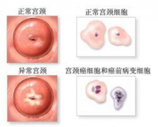 宫颈糜烂到底要不要治疗