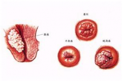 宫颈糜烂怎么样治疗?